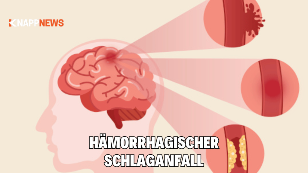 hämorrhagischer schlaganfall